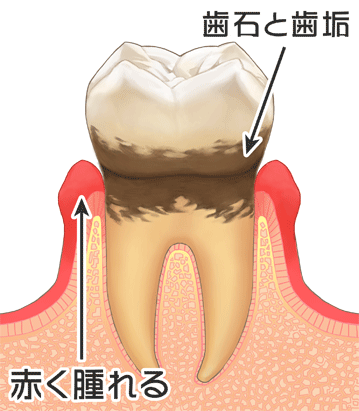 歯周病